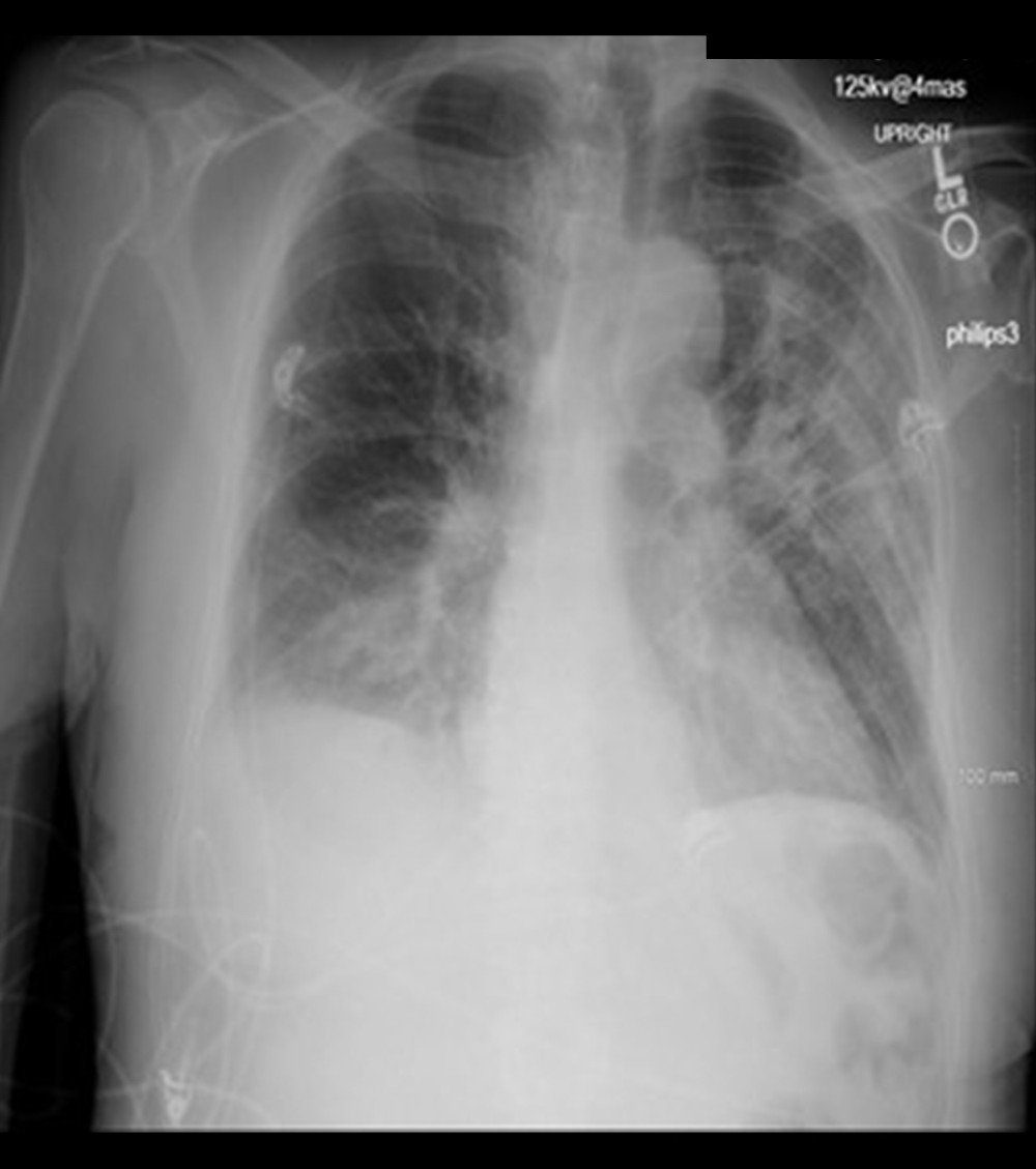Chest X-ray showing right-sided pleural effusion, with bilateral interstitial infiltrates more on the left side.
