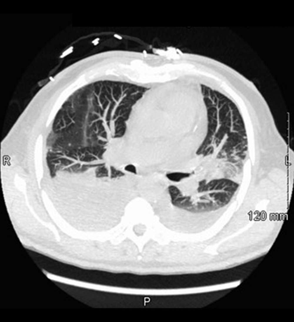 Computed tomography of the chest with intravenous contrast showed bilateral pleural effusion with left-sided infiltrates. The effusion on the right was larger than on the left.