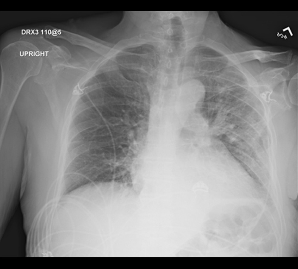 After bilateral thoracentesis, a chest X-ray on the discharge date showed complete resolution of the right pleural effusion.