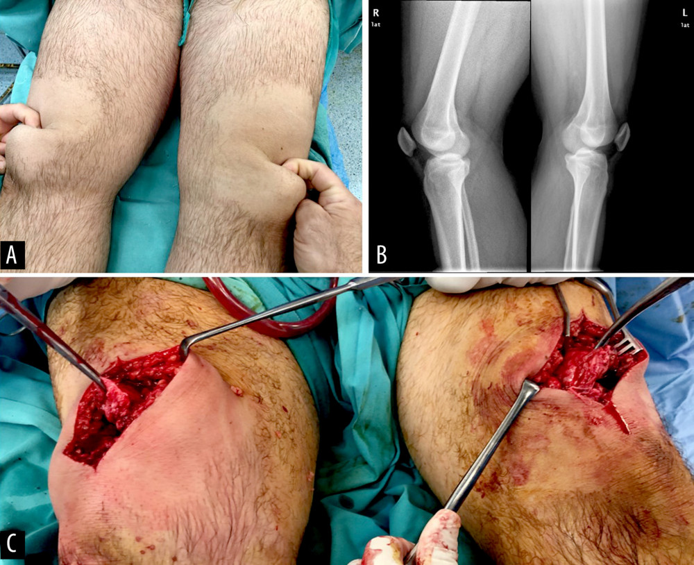 (A) Intraoperative clinical picture demonstrating bilateral suprapatellar gap due to complete disruption of quadriceps tendons at bone interface, (B) lateral radiographs showing patella baja, without evidence of tendinitis or spur formation, (C) intraoperative picture showing bilateral quadriceps rupture.