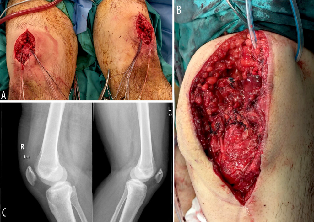 (A, B) Intraoperative picture showing the application of bone anchors in the upper pole of the patella in both knees and the final repair in the left side, (C) postoperative lateral radiographs showing the position of the anchors and the corrected patella height.