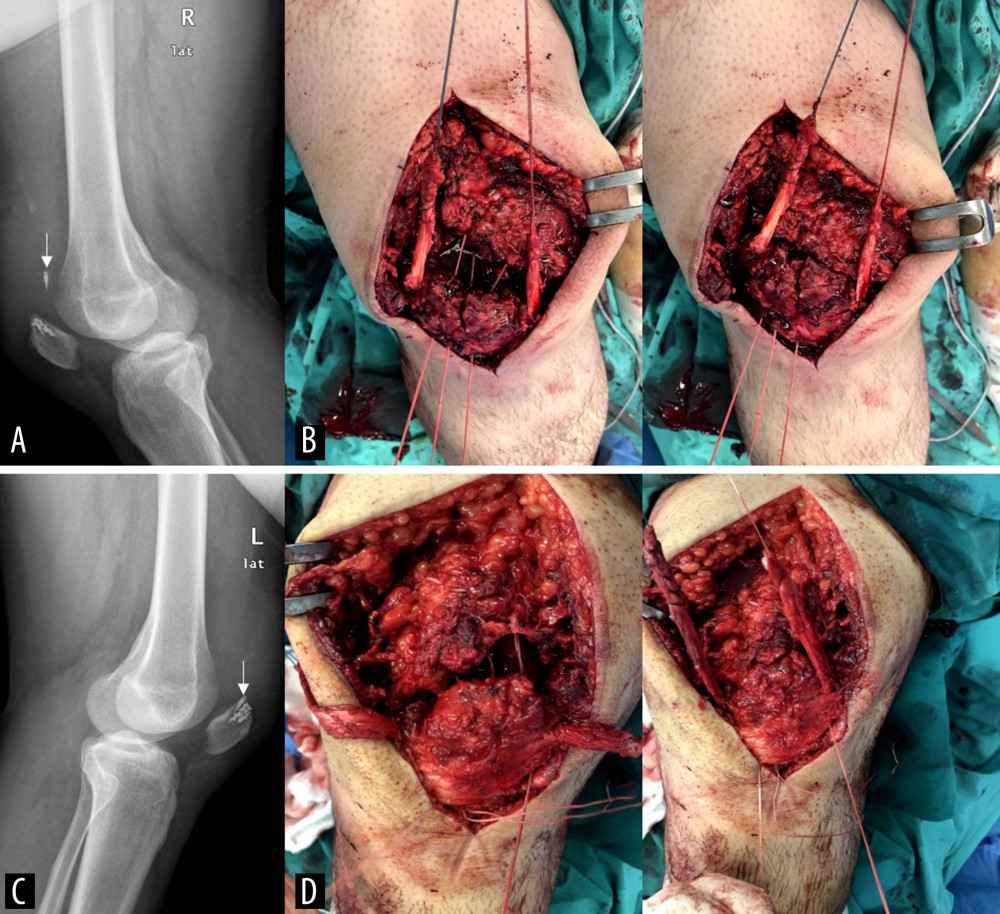 (A, C) Lateral radiographs at 3.5 months follow-up, after the new incidence of bilateral ruptures of quadriceps tendons, showing mild ossification, patella baja and pull-out of 1 of the anchors in both knees (arrows), (B, D) intraoperative pictures of both knees showing the transosseous drill holes in the patella; the quadriceps tendons were reapproximated while pulling the sutures, and each limb of the middle tunnel was firmly tied with the ipsilateral pair of the medial and lateral sides. The Achilles tendon allograft that had passed in the middle of the patella prior to drilling was then passed through quadriceps substance and was sutured to itself in 60 degrees of flexion.