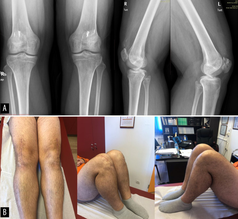 (A) Final radiological evaluation at 18 months follow-up demonstrating good alignment and height of the patella; there was 1 pulled anchor in the tendon substance at the left side that was not visible to be removed at the revision surgery, (B) range of motion in both knees at 18 months follow-up.