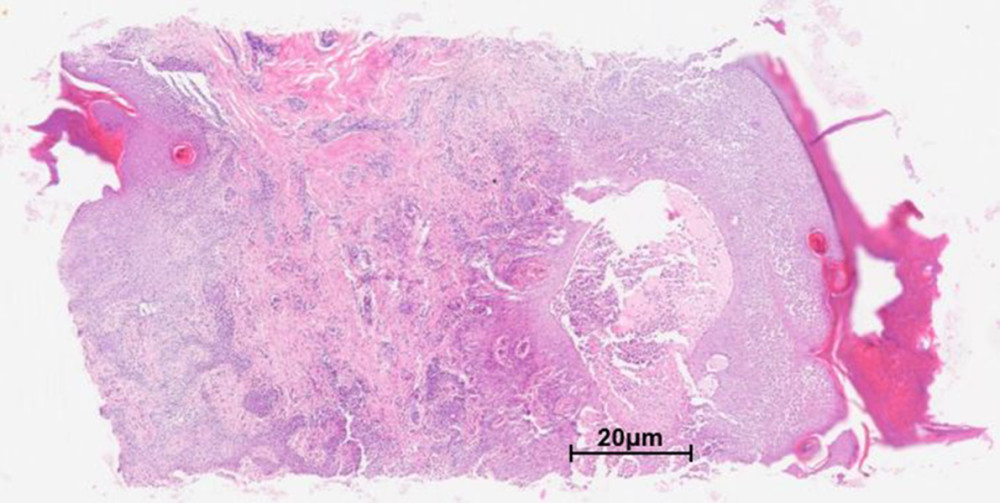 Histopathological analysis of the skin biopsy showed significant edema and subepidermal intraepithelial blister formation with numerous granulomatous eosinophils (Hematoxylin and eosin stain, original magnification ×200) (ImageJ, LOCI).