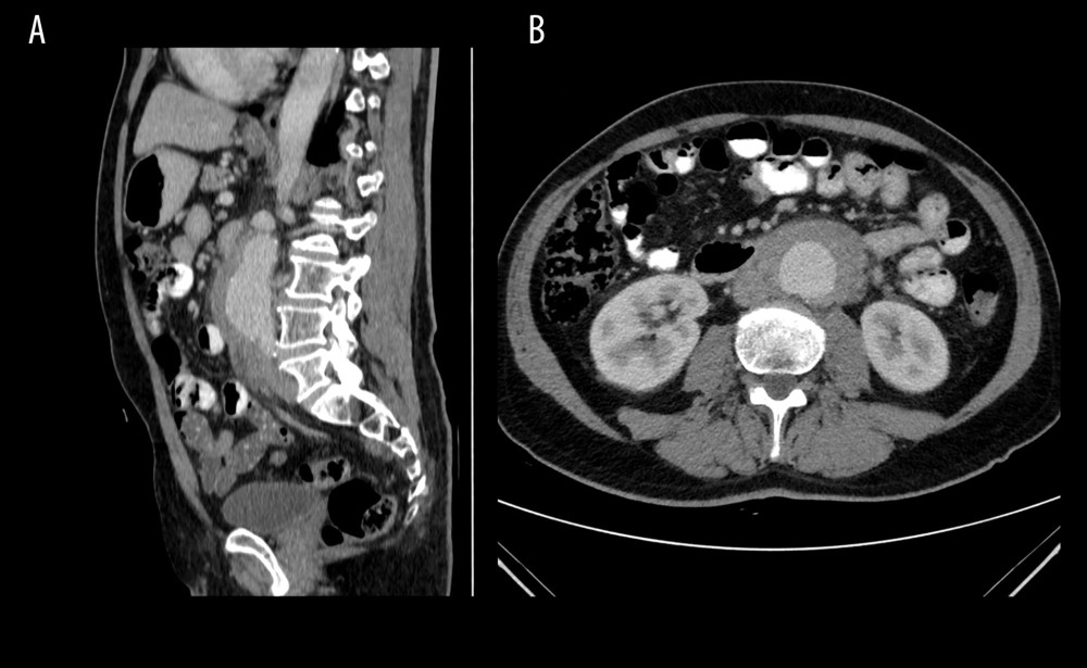 (A) Sagittal and (B) axial computed tomography images showing aortic aneurysmal dilatation involving the infrarenal portion of the abdominal aorta associated with a mantle of periaortic soft tissue thickening.