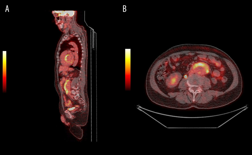 (A) Sagittal and (B) axial images of positron emission tomography showing aortic aneurysmal dilatation involving the infrarenal portion of the abdominal aorta associated with hypermetabolic soft tissue thickening consistent with active periaortitis.