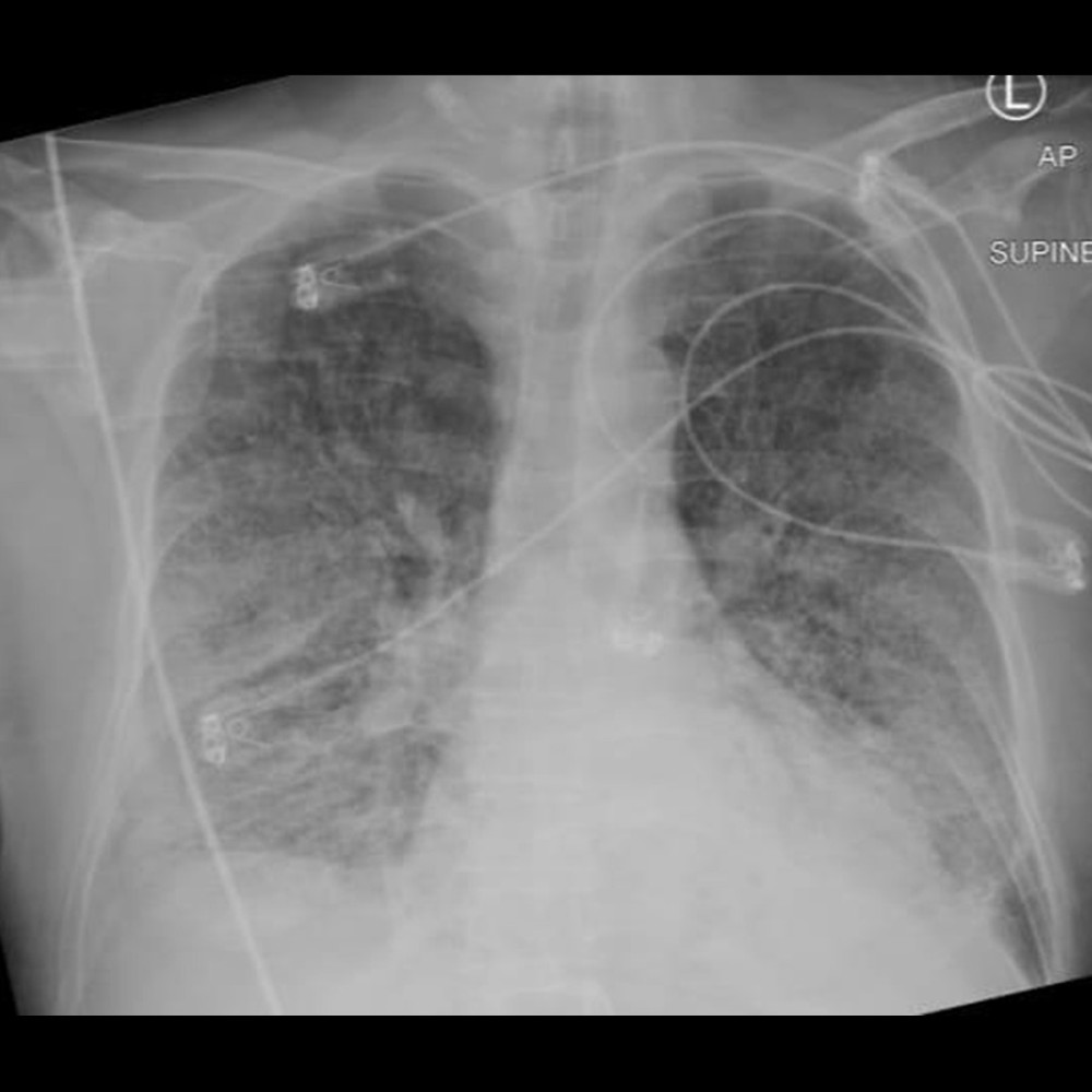 A thoracic radiograph showing diffuse reticulonodular shadowing observed in middle and lower lung zones bilaterally with mild right-sided pleural effusion.