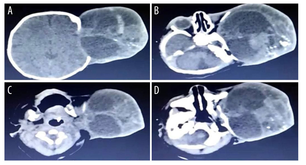 Horizontal cuts of the CT scan (A–D; are from highest to lowest): the cuts show the enormous teratoma invading the frontal, temporal, parietal, and occipital lobes at the time of diagnosis.