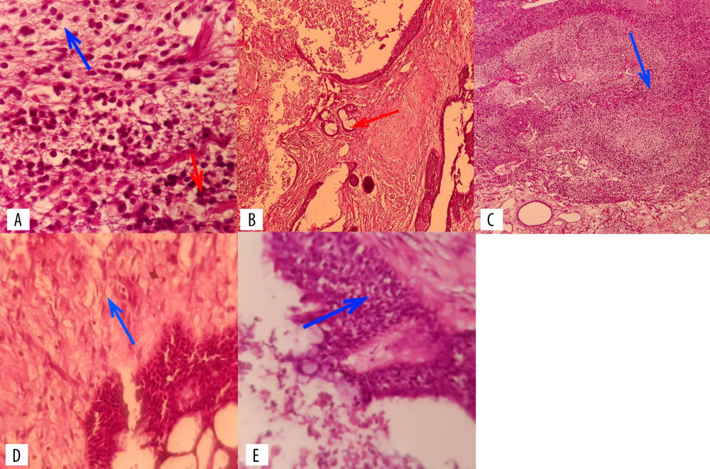 Different tissue specimens under the microscope. Sections showed a mixture of embryonal and adult tissues derived from all 3 germ layers in solid and cystic fashion. Immature primitive neuroepithelial elements were seen in multiple foci. Figure A–E represent different parts of the teratoma tissue under microscope with 40-power magnification and hematoxylin and eosin staining) In Figure A, red arrow shows neural tissue in a glial texture shown with blue. In Figure B, skin tissue is shown with pilosebaceous elements shown with red arrow. Figure C shows immature neural tissue and cellular foci with small round to oval cells presenting immature cells in loose stroma shown with blue arrow. Figure D shows glial tissue with red arrow. Figure E presents immature epithelial tissue resembling both skin and lung epithelial tissue, shown with blue arrow.