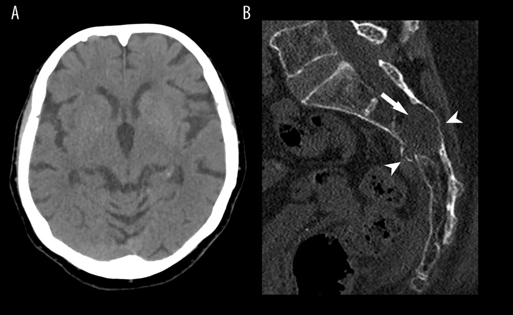 (A) Axial non-contrast computed tomography images in the soft tissue window at the interthalamic adhesion level at presentation (1 day after trauma). (B) Sagittal non-contrast computed tomography images in the bone window showed a comminuted sacral fracture (arrowheads) extending into a meningeal cyst (arrow) within the right S2 foramen.
