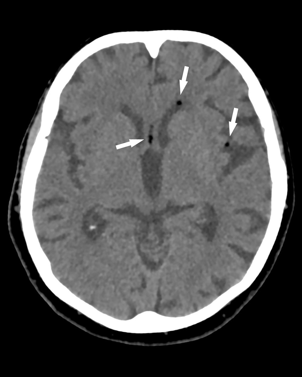 Three days after the trauma, fat droplets (arrows) were seen in the most anterior aspect of the frontal horns of the lateral ventricles, left Sylvian fissure, and the cistern of the lamina terminalis.