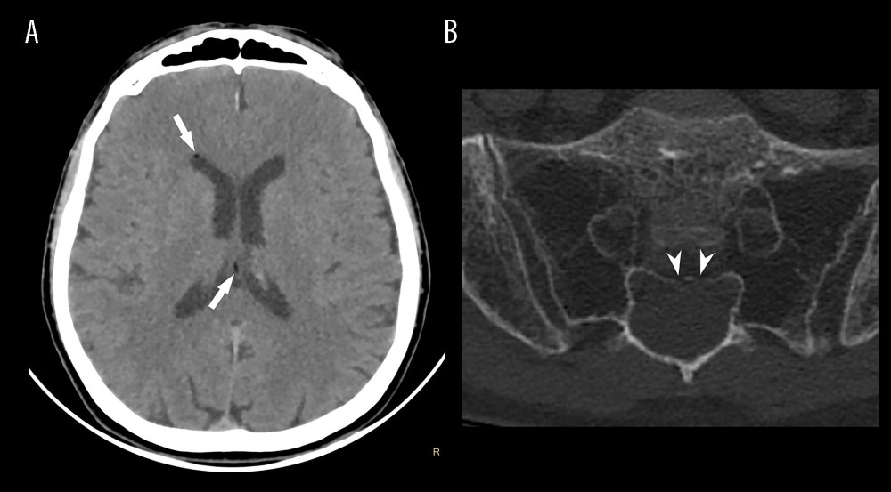 (A) Axial non-contrast head computed tomography images in the soft tissue window showed fat droplets in the 3rd ventricle and right lateral ventricle (arrows). (B) An axial non-contrast computed tomography image showed an expansive cystic lesion within the right S2 foramen that is isodense to cerebrospinal fluid, with several undisplaced microfractures in its wall (arrowheads).