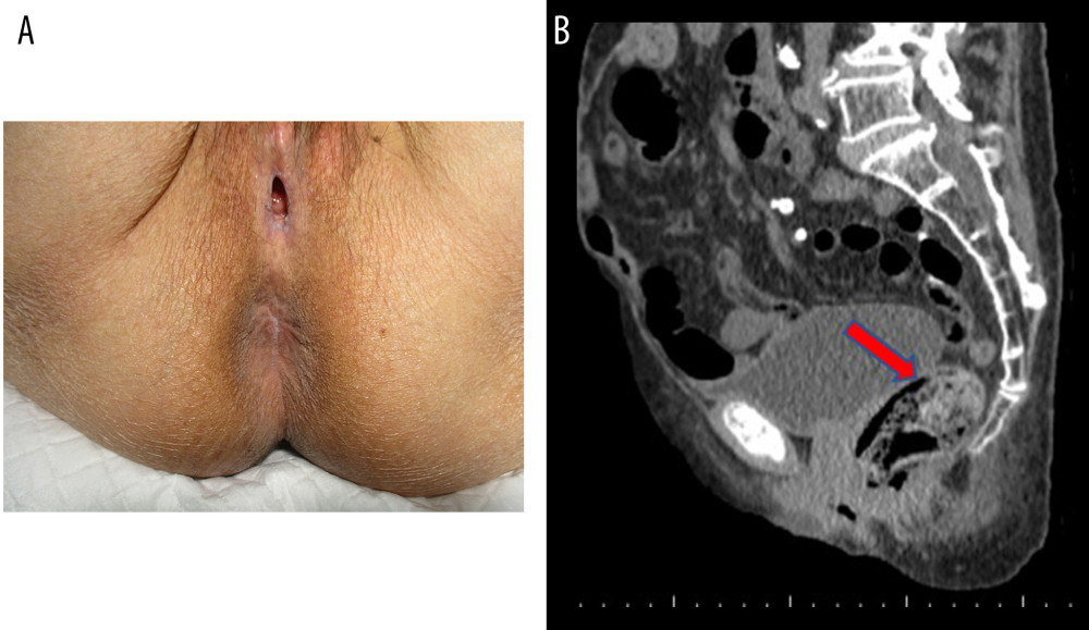 The patient’s anus covered with normal skin and fully obstructed. The patient’s labia show adhesions. The vagina and external urethral openings are not obstructed (A). Sagittal view CT scan with arrow pointing toward the diverted rectum filled with stool and gas (B).