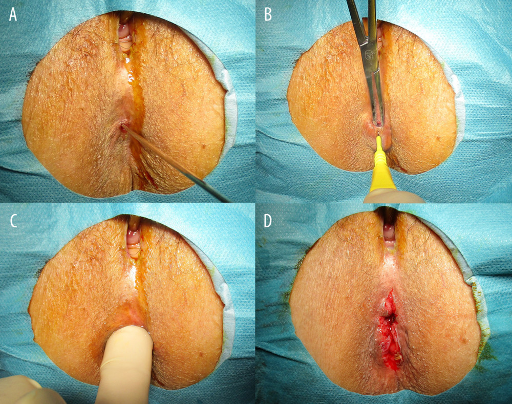 A probe was passed through the anal skin into the rectum (A). An incision was made in the anal skin (B). The index finger was inserted into the anus (C). The anus was confirmed to be unobstructed (D).