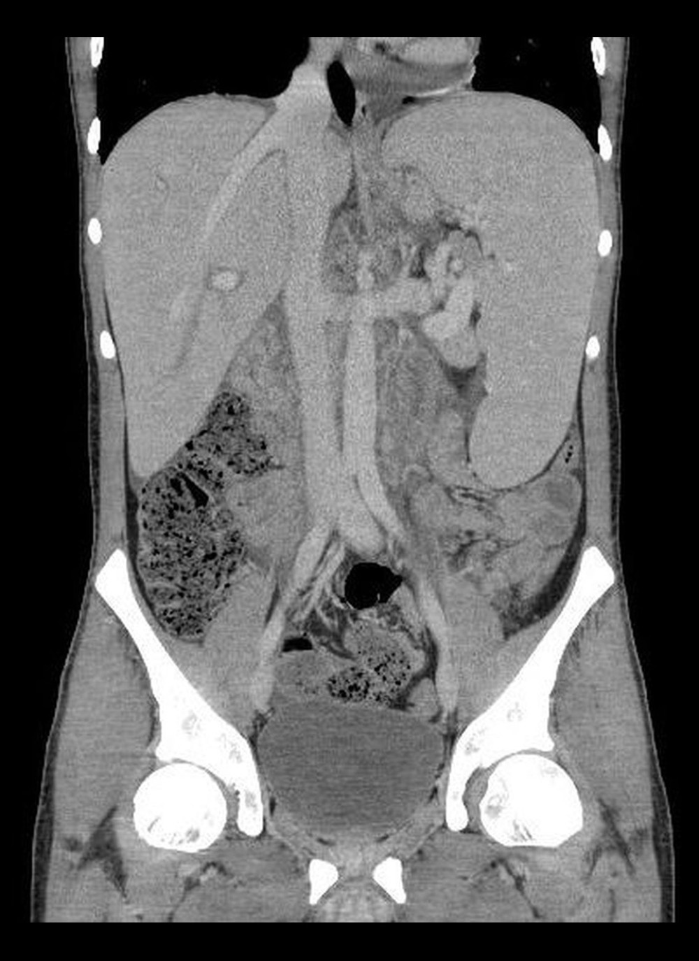 Computed tomography (coronal plane) of the abdomen shows hepatosplenomegaly. Enlargement of the liver up to 23 cm, and spleen up to 23 cm with the presence of a subcapsular rupture in the lower pole of about 13 mm, and numerous retroperitoneal enlarged lymph nodes. (Alteris ver. 1.0.9.97 DicomVision).