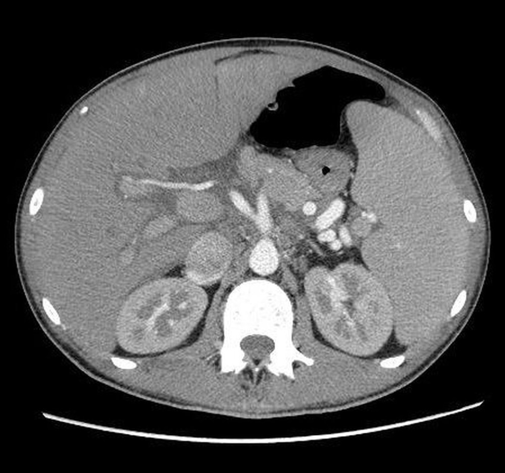 Computed tomography (axial plane) of the abdomen shows hepatosplenomegaly. Enlargement of the liver up to 23 cm and spleen up to 23 cm with the presence of a subcapsular rupture in the lower pole of about 13 mm, with numerous retroperitoneal enlarged lymph nodes. (Alteris ver. 1.0.9.97 DicomVision).