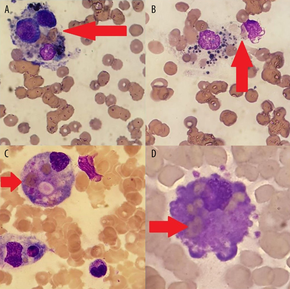(A–D) Bone marrow smear reveals activated macrophages with phagocytosis of red blood cells marked by red arrows (May-Grunwald-Giemsa; Microsoft Paint ver. 10.0.19041.746).