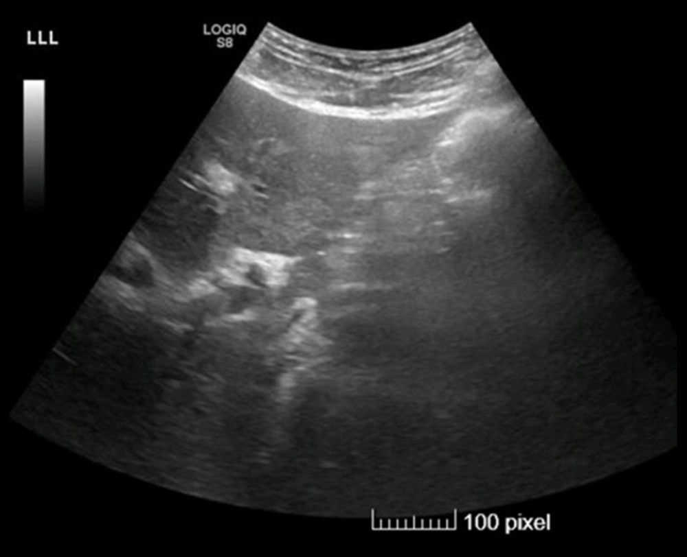 US abdomen showing gallbladder thickened wall (5 mm) with multiple stones.