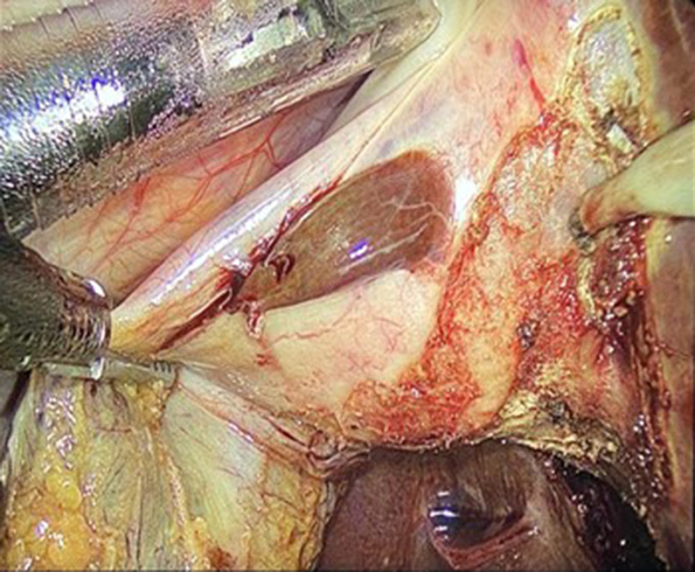 Ectopic liver tissue on the gallbladder during laparoscopic cholecystectomy.