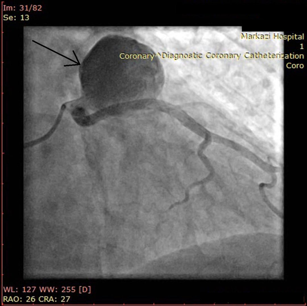 Coronary angiography of the patient shows GCAA at the origin of the LAD.