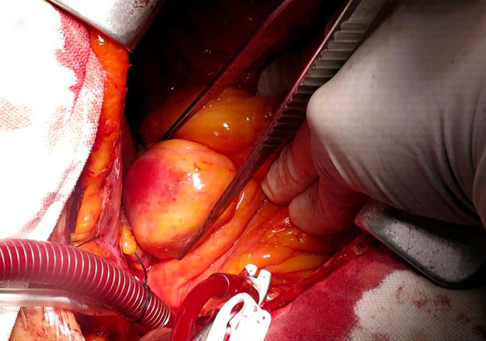 Giant coronary artery aneurysm of the patient.