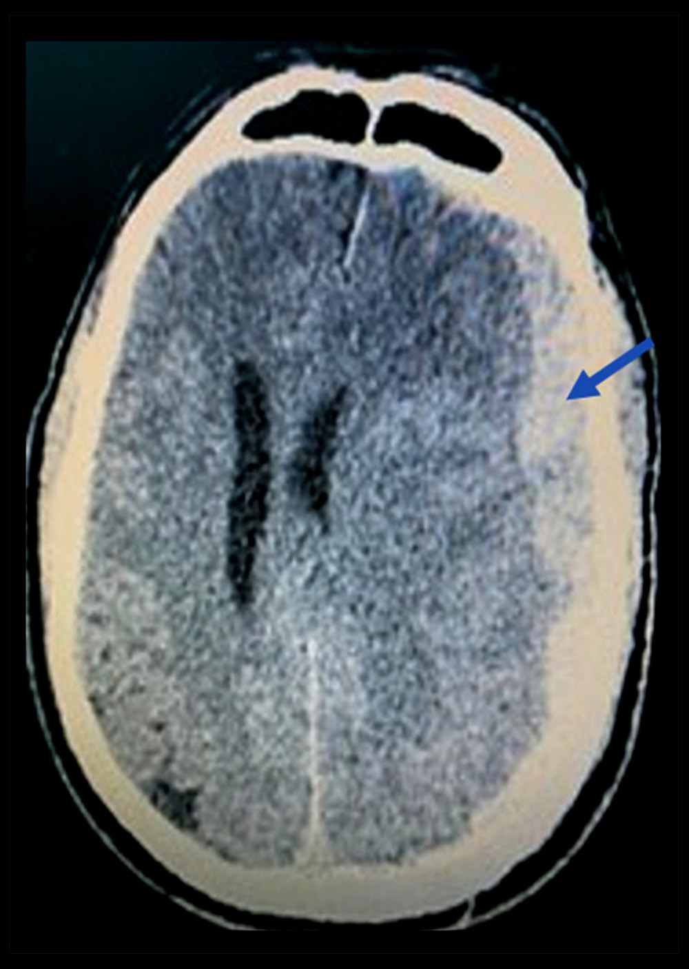 Initial CT brain (7 h from initial symptoms) showing extra-axial collection. Description: left-sided extra-axial hyperdensity 2 cm in maximum thickness (pointed in the image) with mass effect and midline shift 1.4 cm, left uncal herniation, and effacement of cortical sulci and left lateral ventricle.