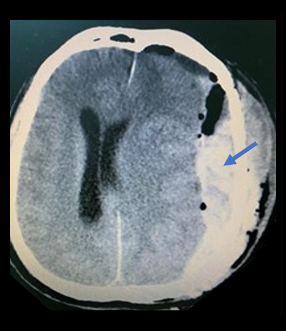 CT brain 6 h after the first evacuation. Description: left-sided craniotomy with pneumocephalus, subgaleal hematoma, and redemonstration of subdural hematoma (pointed in the image) with midline shift 17 mm and uncal herniation.