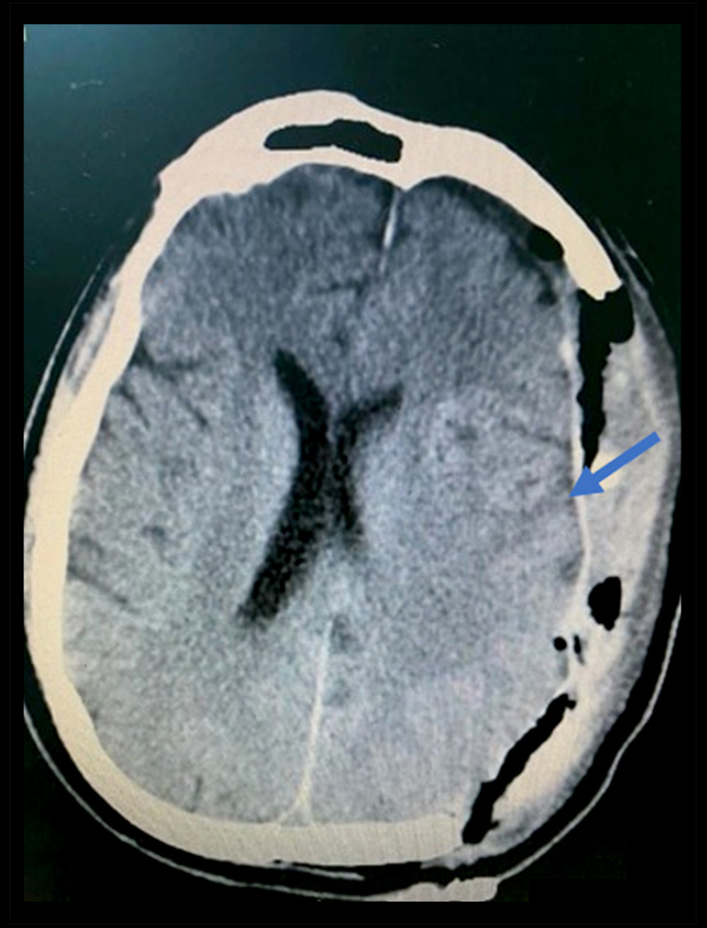 CT brain day 1 after the second evacuation of subdural hematoma and decompressive craniectomy. Description: significant improvement of left extra-axial hematoma (pointed in the image) with improvement of midline shift from 17 mm to 7 mm.