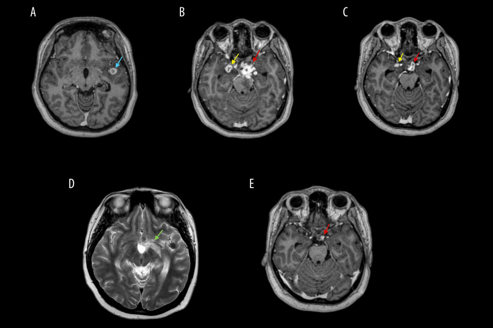 (A) Multiple enhancing lesions of varying sizes scattered predominantly in the supratentorial brain. Most of them depicted a hypointense signal on T2-weighted image and T1-weighted image with rim enhancement after gadolinium contrast. (B) Some of the lesions coalesced, representing a conglomerate of tubercular micro-granulomas. (C) The lesions decreased in number and size but retained similar imaging characteristics as those of caseating granulomas, without central T2-weighted image hyperintensity to suggest progression to central liquefaction or tuberculous abscesses. (D) Increasing perilesional edema at the left medial temporal lobe associated with the left suprasellar lesions. (E) Residual lesions of the left suprasellar tuberculomas conglomerates.