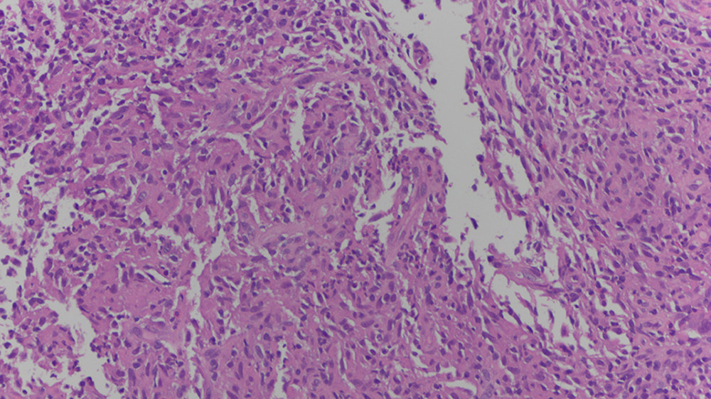 Histopathology of 1 of 13 left Prostate Imaging-Reporting and Data Stem 5 lesion biopsies (20 objective).