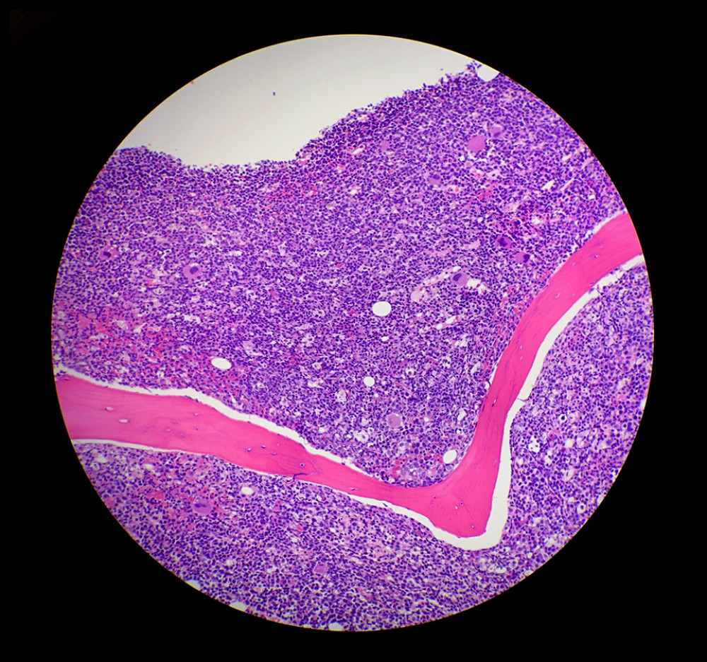 Bone marrow biopsy showing hyperfractionated infiltration of blastoid cells.