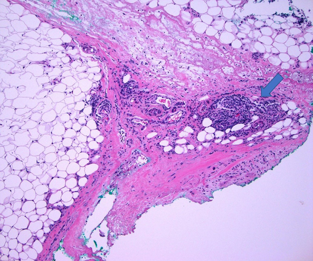 Thickened hyalinized and edematous septa showing mononuclear infiltrate (arrow) and scant eosinophils (hematoxylin and eosin staining;100×).
