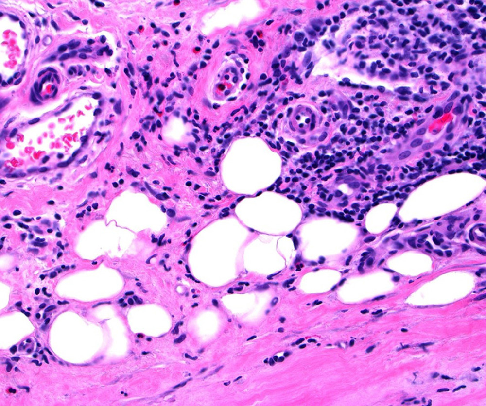 Septa showing mononuclear infiltrate and scant eosinophils (hematoxylin and eosin staining; 400×).