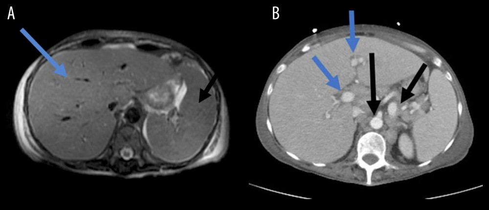 MRI images of the abdomen. (A) Axial MRI image showing extensive hepatic (blue arrow) and splenic (black arrow) enlargement (B) Axial CT image showing extensive hepatic lesions (blue arrow) and mesenteric lymphadenopathy (black arrow).