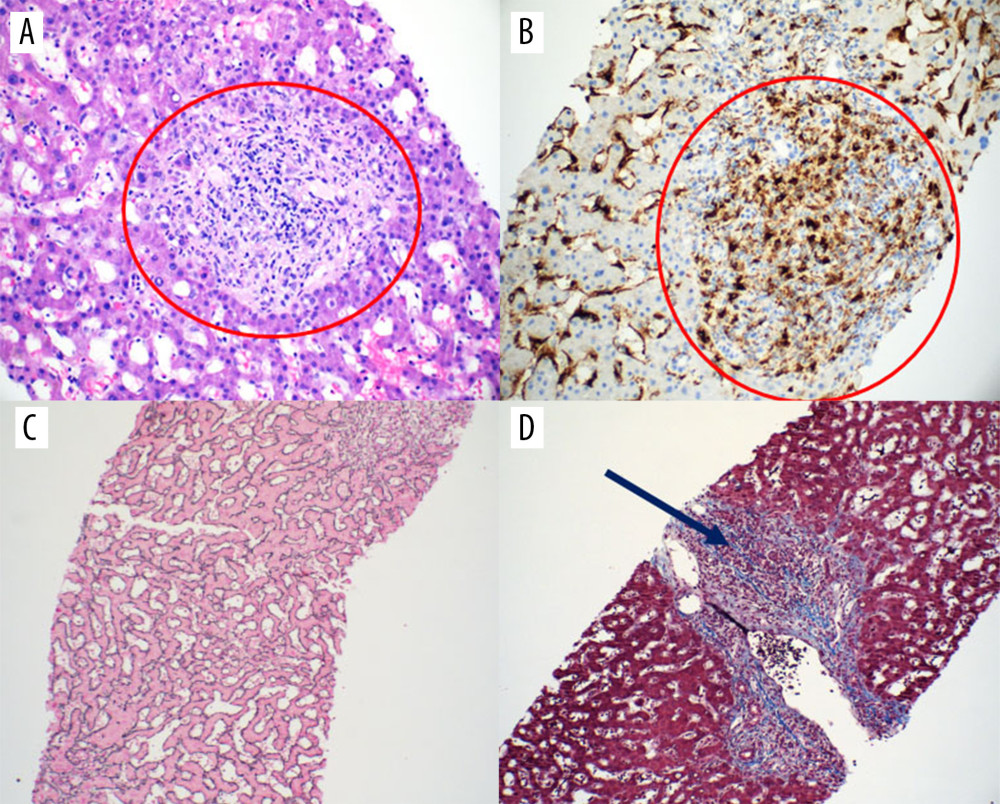 Biopsy of the liver. (A) Hepatic cells with periportal area (red circle) showing infiltration with inflammatory cells. (B) The immunostaining for CD68 highlights the histiocytic infiltration in the periportal area (red oval). (C, D) The reticulin and trichrome stains highlight the unremarkable hepatic parenchyma and extensive periportal fibrosis (arrow), respectively.