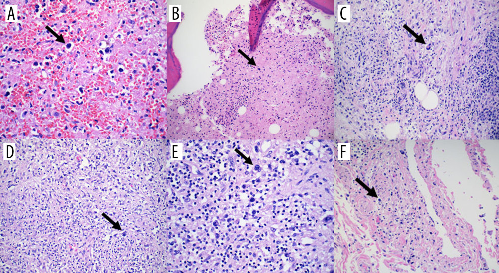 Multisystem involvement by HL. The atypical cells (arrows) identified in the spleen (A), bone marrow (B), pancreas (C), hilar lymph node (D), lung (E), and fallopian tube (F) suggest the extensive dissemination of RT HL to organs.