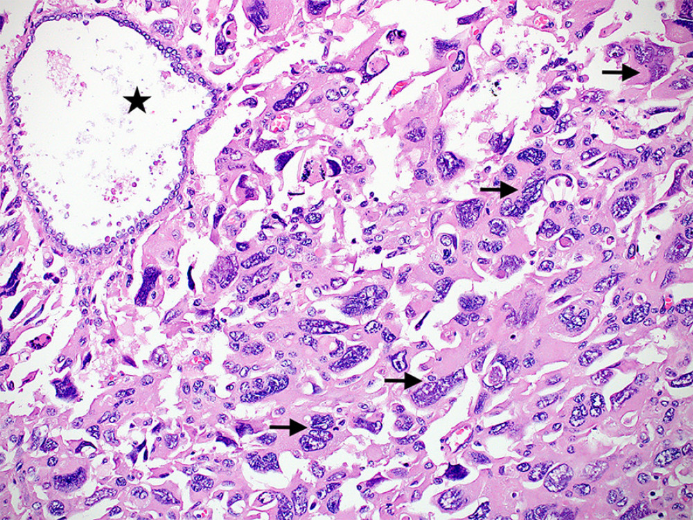A photomicrograph showing sheets of multinucleated tumor cells (arrows) with abundant dense eosinophilic cytoplasm and marked nuclear pleomorphism, with an entrapped non-neoplastic gland (star). (Hematoxylin and eosin stain, ×200 magnifications) (CellSens Entry 1.18, Olympus).