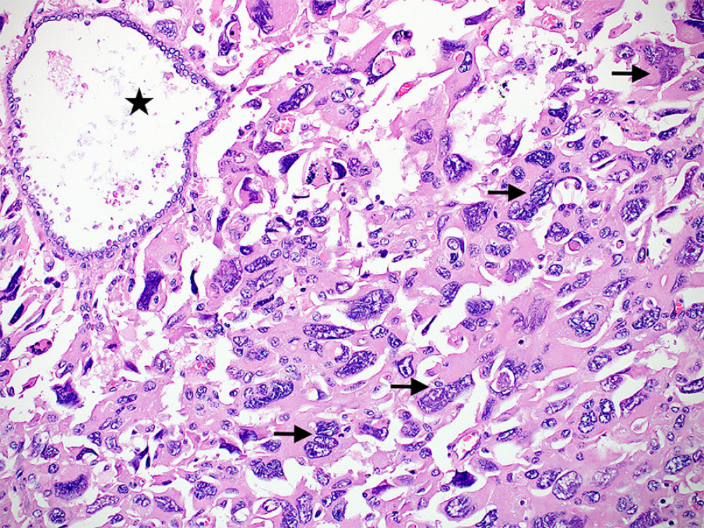 A photomicrograph showing sheets of multinucleated tumor cells (arrows) with abundant dense eosinophilic cytoplasm and marked nuclear pleomorphism, with an entrapped non-neoplastic gland (star). (Hematoxylin and eosin stain, ×200 magnifications) (CellSens Entry 1.18, Olympus).