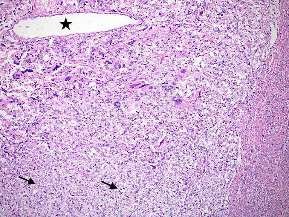 A low-magnification image showing the giant cell carcinoma component and the minor component of undifferentiated carcinoma (arrows). A single entrapped endometrial gland is also noted (star) (Hematoxylin and eosin stain, ×100 magnifications) (CellSens Entry 1.18, Olympus).