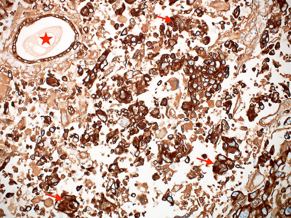 CAM5.2 immunohistochemical stain showing positive staining in both the tumor cells (arrows) and the entrapped non-neoplastic gland (star). (CAM5.2, ×200 magnification) (CellSens Entry 1.18, Olympus).