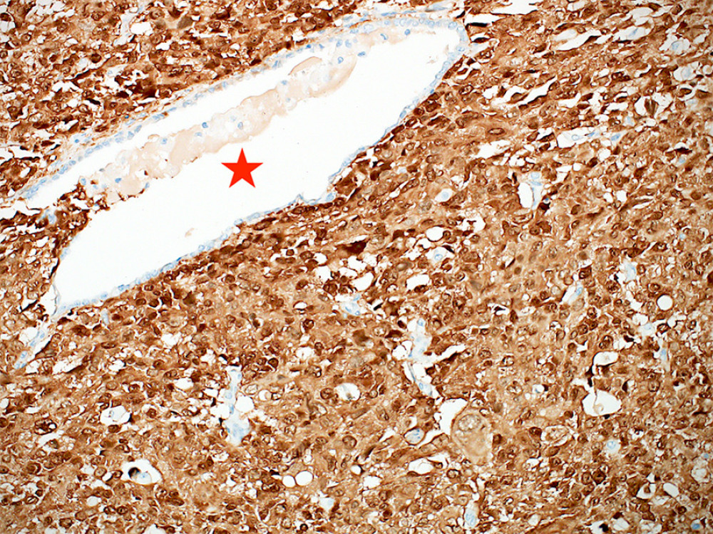 p16 immunohistochemical stain showing nuclear and cytoplasmic staining in tumor cells. An entrapped nonneoplastic gland is shown for comparison (star) (p16, ×200 magnification) (CellSens Entry 1.18, Olympus).