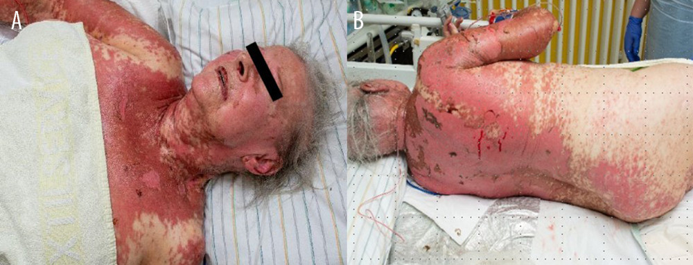 (A, B) Examples of the extension of toxic epidermal necrolysis.