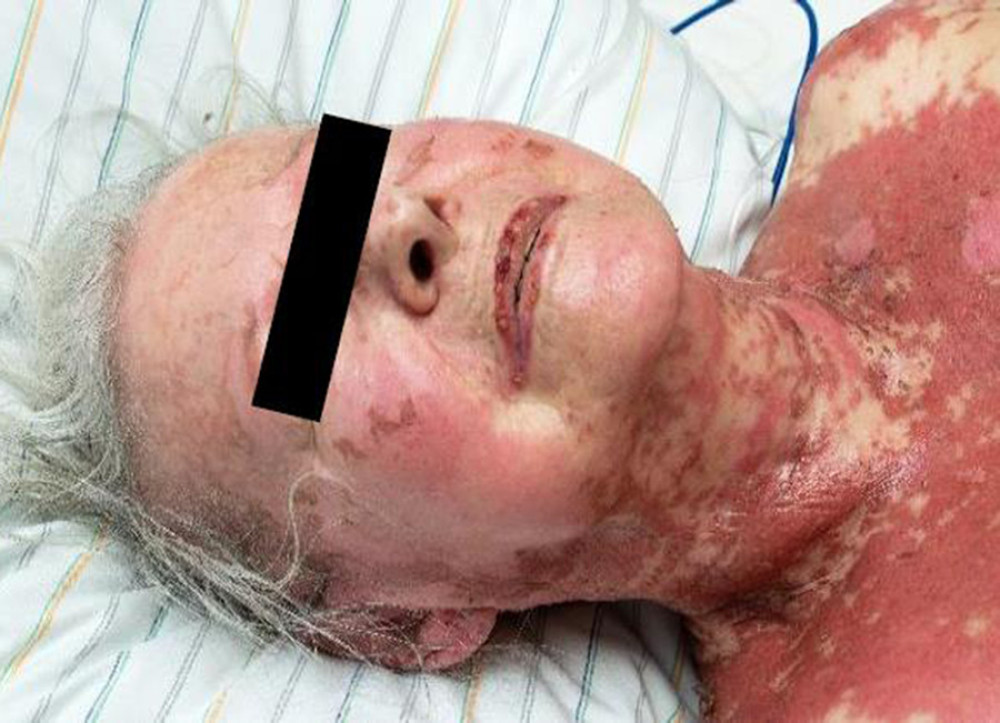 Representative image of the effect of toxic epidermal necrolysis on mucosal tissue (eg, lips).