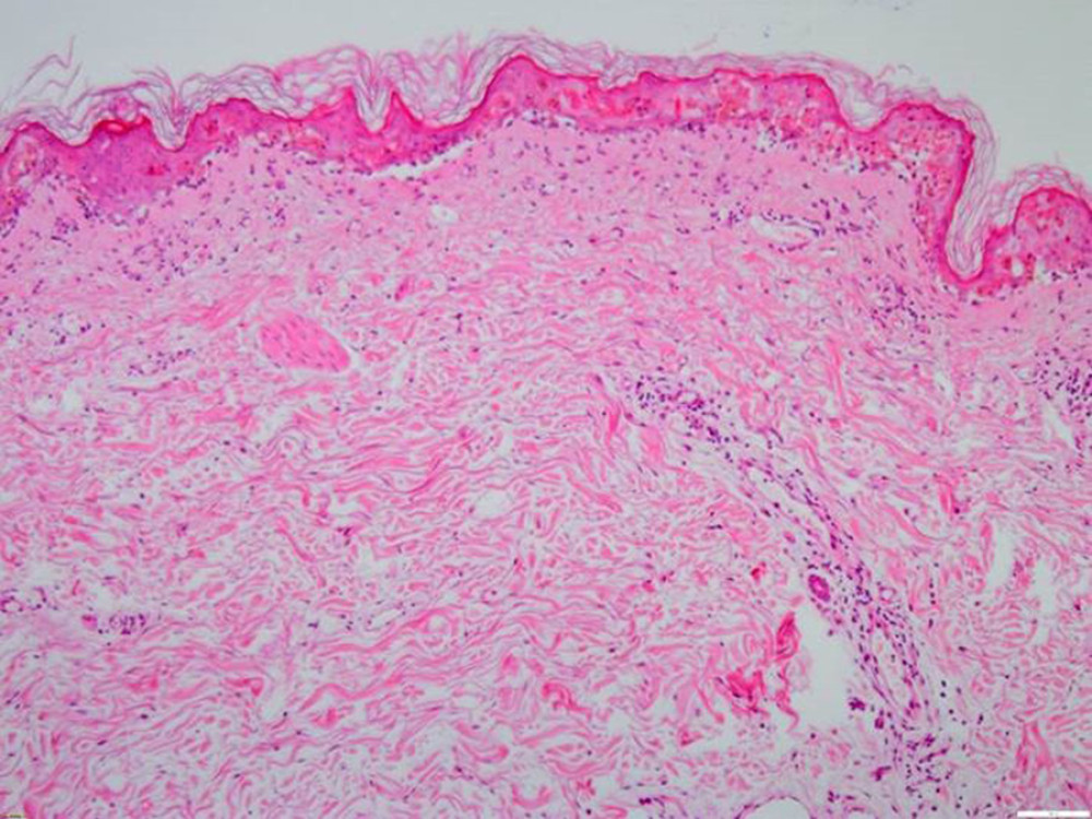 Zoomed microscopic view of skin biopsy showing necrotic basal and suprabasal epidermis with beginning of junctional separation, sparse lymphocytic infiltrates, apoptotic keratinocytes, and ectatic vessels in the upper corium.