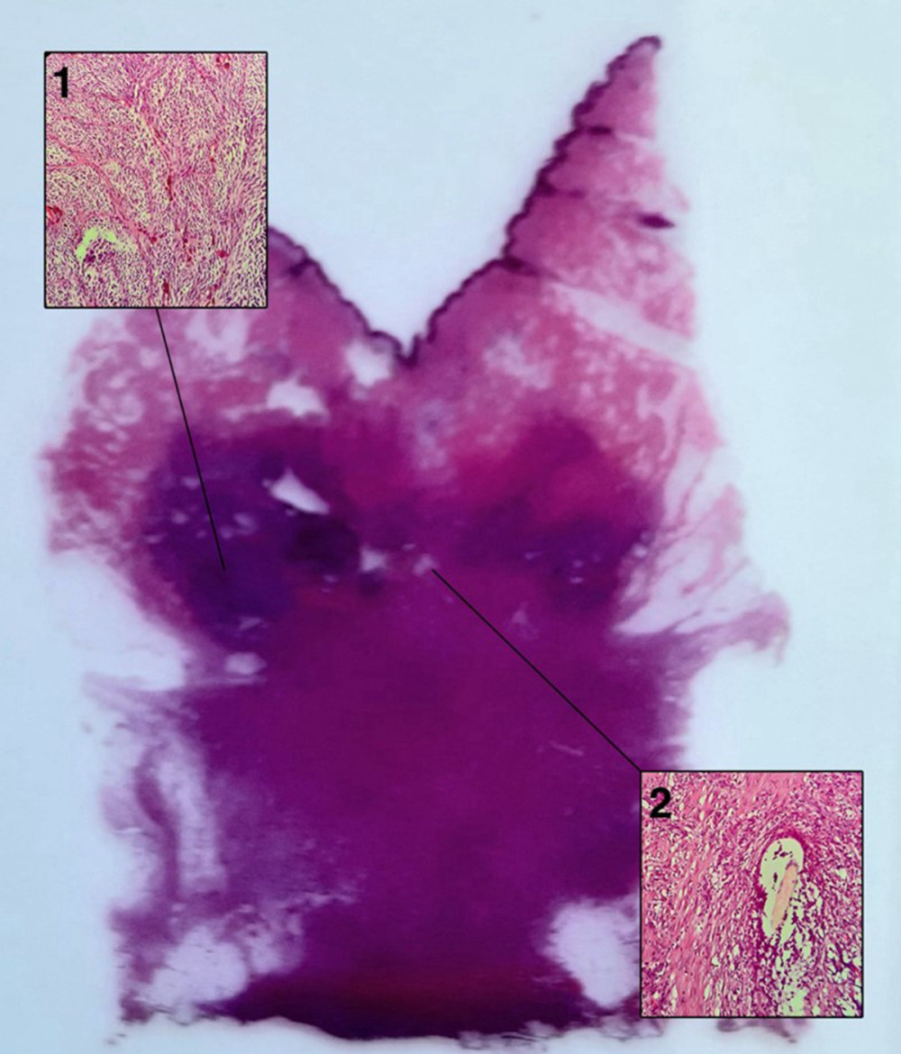 A histologic specimen (H&E, 40×) of the excised pilonidal sinus. 1. Poorly circumscribed desmoplastic melanoma showing fascicular pattern of spindle cells with desmoplastic stroma.2. A hair follicle.