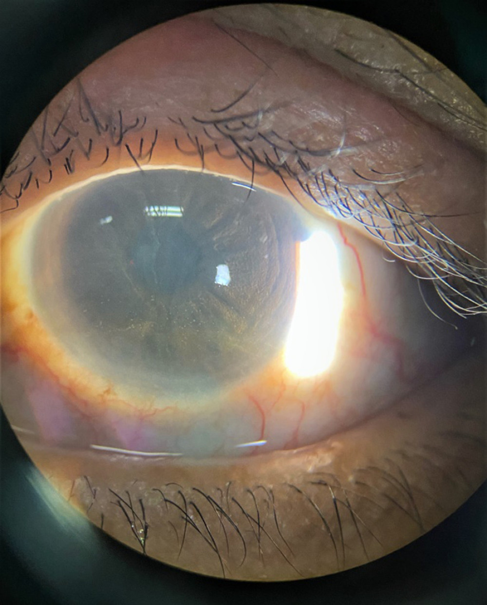 Cornea verticillata found in the left eye of index patient 1.