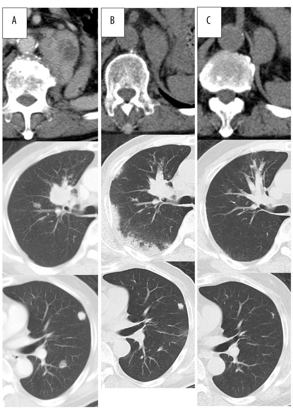 The CT scan shows left adrenal and lung metastases before initial nivolumab therapy (A), after 3 cycles of nivolumab therapy (B), and 7 months after nivolumab discontinuation (C).