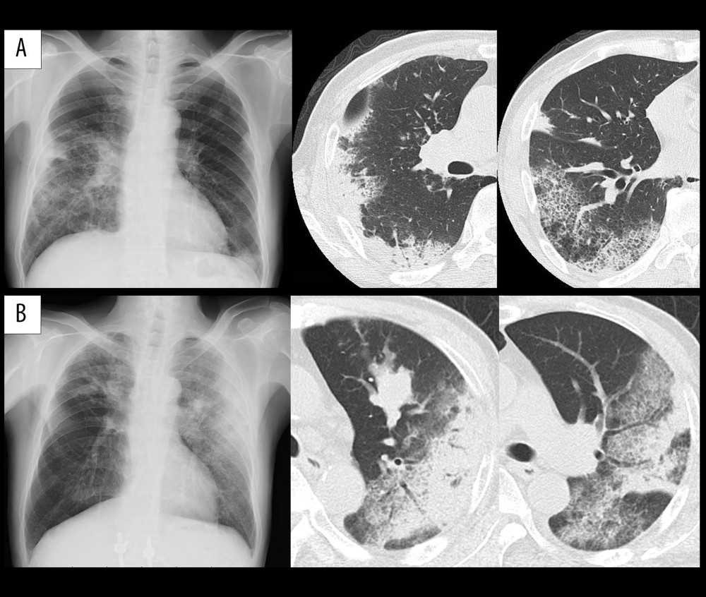 X-rays and CT when interstitial pneumonia appeared. (A) Interstitial pneumonia after 3 cycles of nivolumab treatment. (B) Recurrence of interstitial pneumonia after re-challenge with nivolumab.