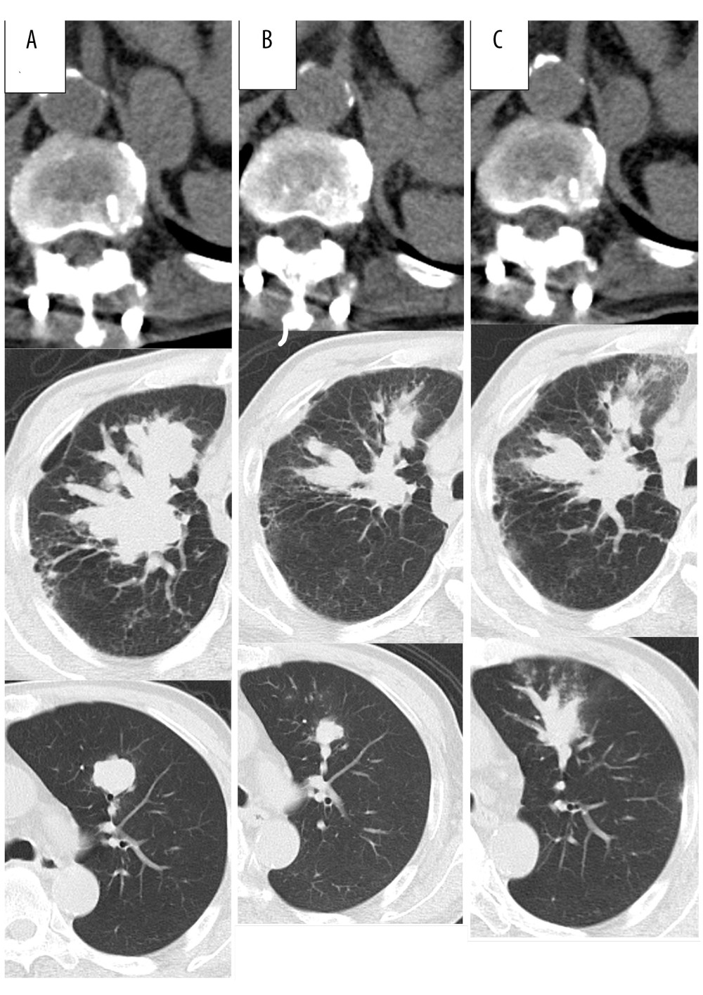 The CT scan shows left adrenal and lung metastases before re-challenge with nivolumab (A), PR after 5 cycles of re-administration (B), and enlarged after 7 cycles of re-administration (C).