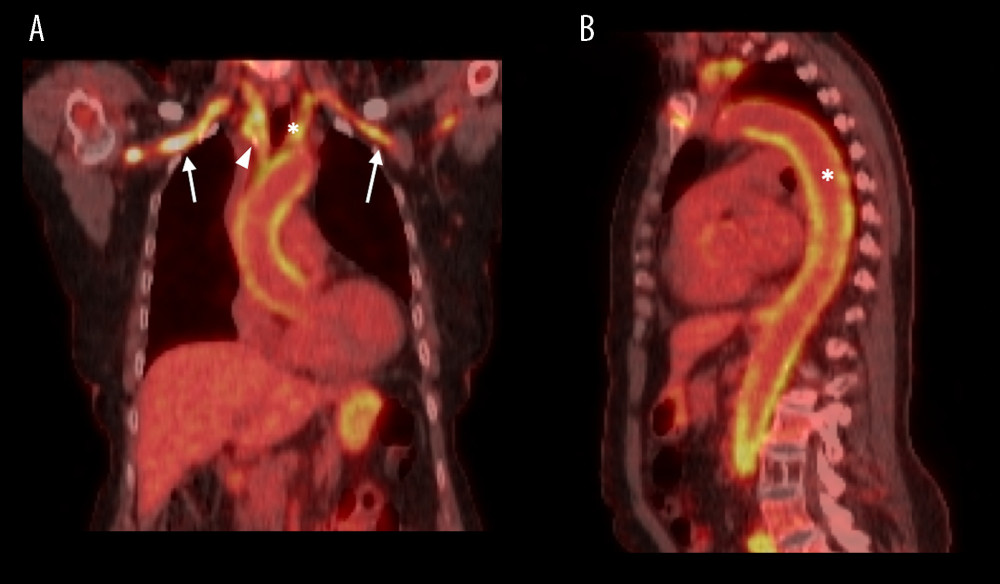 Positron emission tomography-computed tomography. (A) Subclavian (arrows), brachiocephalic (arrowhead), and left common carotid (asterisk) arteries with radiotracer uptake indicating diffuse vessel wall inflammation. (B) Aorta (asterisk) with radiotracer uptake indicating diffuse aortitis.